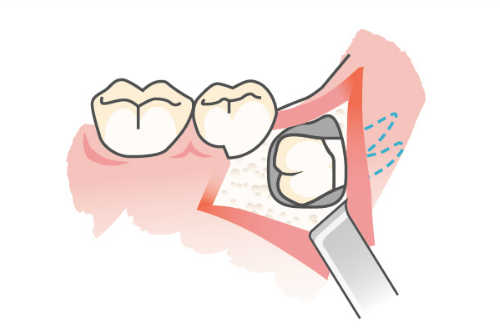 親知らずの抜歯