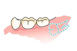 親知らずの抜歯