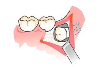 歯肉の剥離