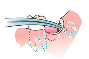 歯根の抜歯
