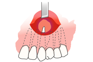 歯根尖切除術